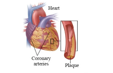 Coronary artery disease