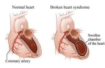 A normal heart showing a coronary artery and a normal chamber, and a heart with broken heart syndrome showing a swollen chamber.