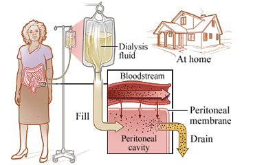 Peritoneal dialysis.
