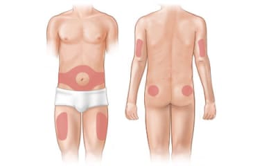 Areas of the body where insulin can be given.