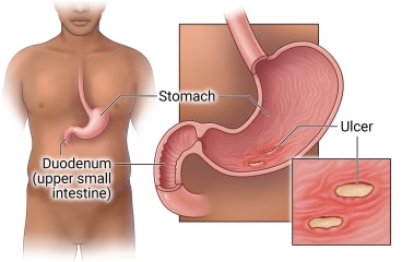 Location of stomach in body, with cross-section of stomach and duodenum (upper small intestine), with detail of ulcers in stomach.