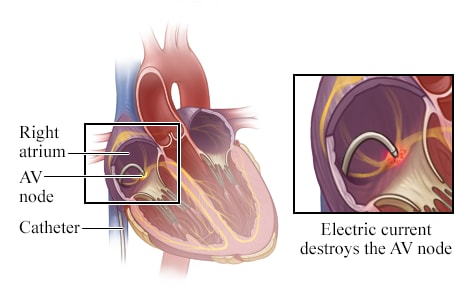 Location of catheter in the heart, with detail of electric current destroying AV node.