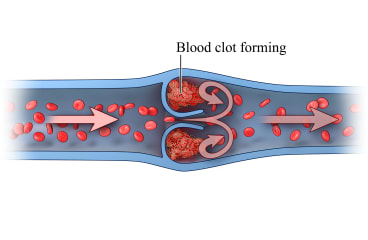 Blood clot forming
