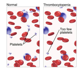 Red and white blood cells and a normal number of platelets, compared with thrombocytopenia, with red and white blood cells and too few platelets.