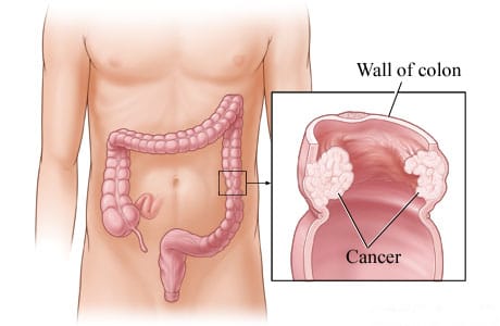 Cancer in the wall of the descending colon Cancer in the wall of the descending colon