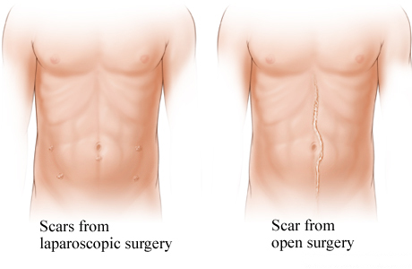 Comparison of laparoscopic surgery scars and open surgery scar Comparison of laparoscopic surgery scars and open surgery scar