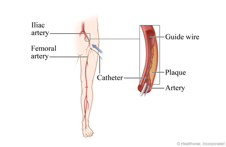 Location of the iliac artery, with detail of the catheter and guide wire inserted in the artery. Location of the iliac artery, with detail of the catheter and guide wire inserted in the artery.