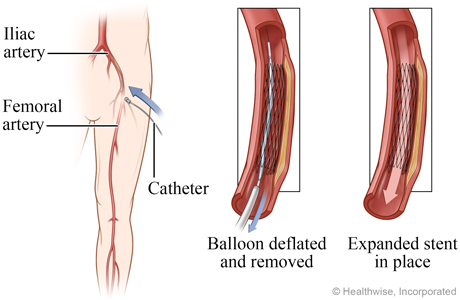 Deflated balloon removed and expanded stent in place. Deflated balloon removed and expanded stent in place.