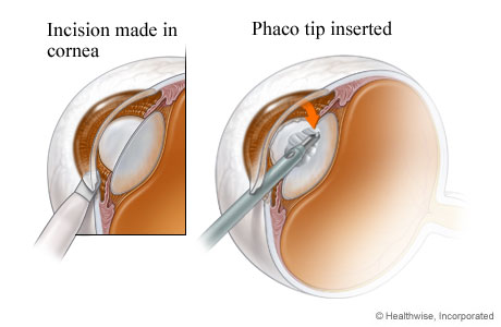 Incisions and opening created to begin cataract surgery Incisions and opening created to begin cataract surgery