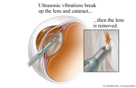 Cataract being broken up using ultrasound and removed using suction Cataract being broken up using ultrasound and removed using suction