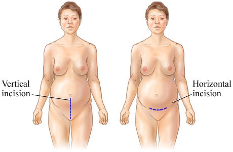 Picture of C-section incisions