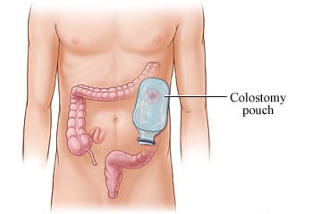 Colostomy pouch