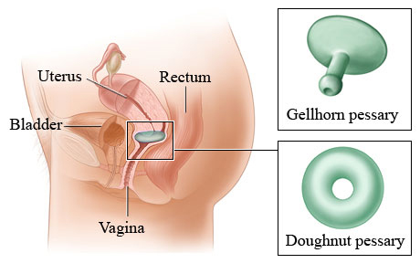 Gellhorn and doughnut pessaries.