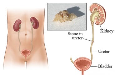 Kidney stone in the ureter