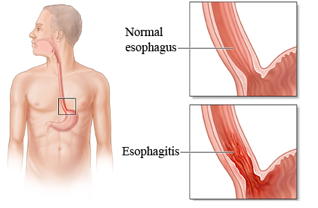 Normal esophagus compared to one with esophagitis