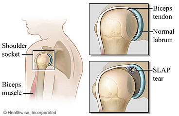 Shoulder and SLAP tear in shouder