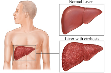 Normal liver and a liver with cirrhosis