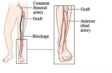 A grafted blood vessel that goes around a blockage