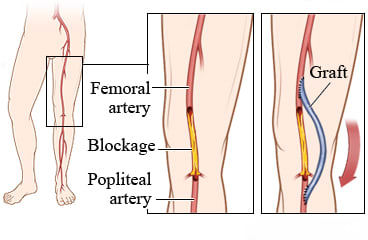 A femoropopliteal bypass surgery