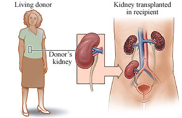 A living donor and kidney transplant