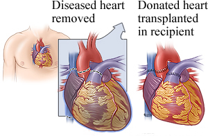 Heart transplant