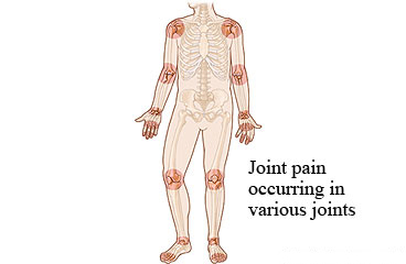 Picture of joint pain regions associated with rheumatoid arthritis