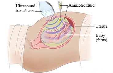 Amniocentesis