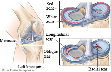 Knee joint with meniscus tears