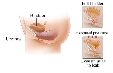 A bladder, a full bladder, and pressure that leads to urine leakage