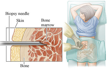 Picture of the facedown position for a bone marrow aspiration and biopsy