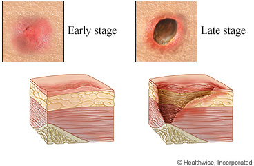 Early-stage and late-stage pressure injuries