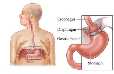 Esophagus and stomach, with a detail of the esophagus, diaphragm, gastric band, and stomach