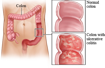 A normal colon and ulcerative colitis