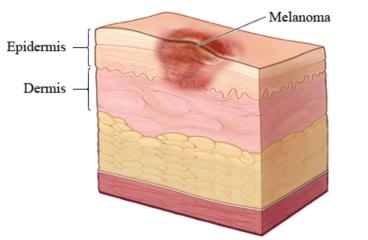 Melanoma