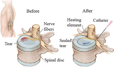 Intradiscal electrothermal therapy (IDET) catheter and heating element placement.