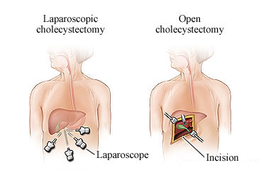 Gallbladder removal (cholecystectomy) showing laparoscopic type with small incisions in the chest and open type with one large incision in the chest