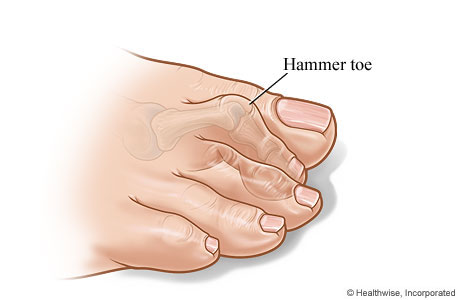 Hammer toe Hammer toe