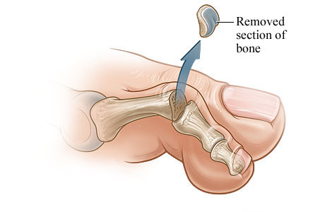 The bone section that is removed The bone section that is removed