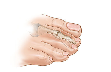 Straightened toe after pin is removed Straightened toe after pin is removed