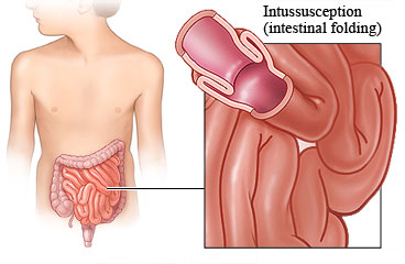 Picture of intussusception