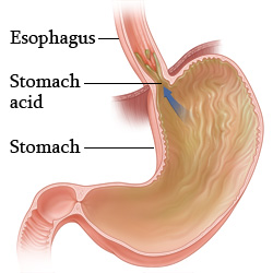 Stomach acid backing up into the esophagus.