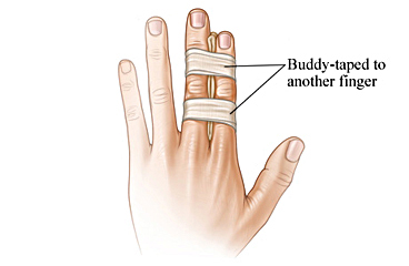 Picture of one finger taped to another