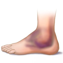 Picture of a bruised ankle