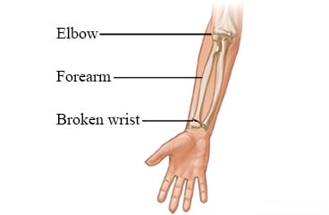 Arm bones and a broken wrist