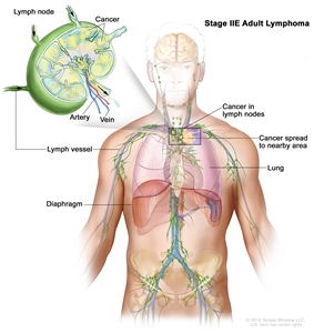 Stage IIE adult lymphoma; drawing shows cancer that has spread from a group of lymph nodes to a nearby area. Also shown is a lung and the diaphragm. An inset shows a lymph node with a lymph vessel, an artery, and a vein. Cancer cells are shown in the lymph node.