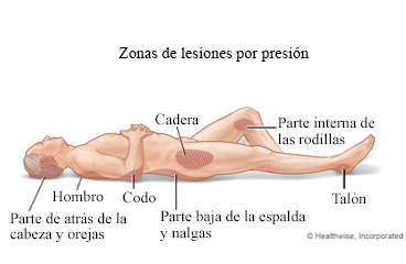 Zonas del cuerpo donde suelen ocurrir las lesiones por presión