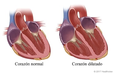 Corte transversal de un corazón normal y un corazón con cavidades dilatadas.