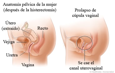 Anatomía pélvica femenina después de la histerectomía que muestra el útero extraído, y anatomía con prolapso de la cúpula vaginal que muestra el canal uterovaginal caído.