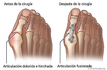 Antes y después de la artrodesis (fusión) de la articulación metatarsofalángica, con detalle de una articulación del dedo del pie hinchada y dolorida antes de la cirugía y detalle de una placa y tornillos en la articulación fusionada del dedo gordo del pie después de la cirugía