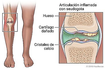Rodilla inflamada con detalle de cristales de calcio y cartílago dañado en el espacio articular